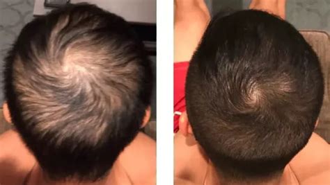 Minoxidil Before and After Photos [2022] | Is it right for you?