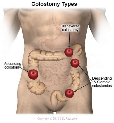 Colostomy Stoma