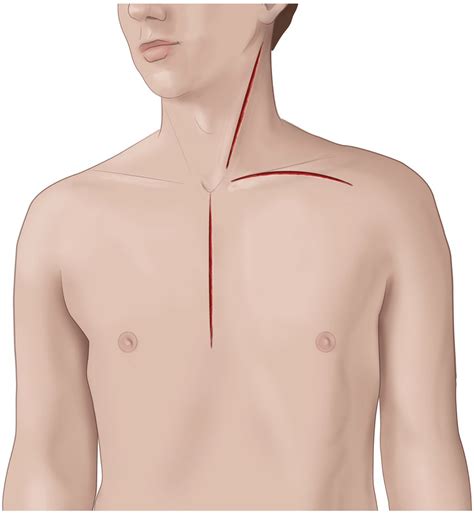 Chapter 7 – Neck Operations for Trauma | Anesthesia Key