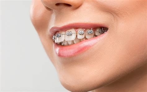 Can I Get Braces with Missing Teeth? - Port Macquarie Dental Centre