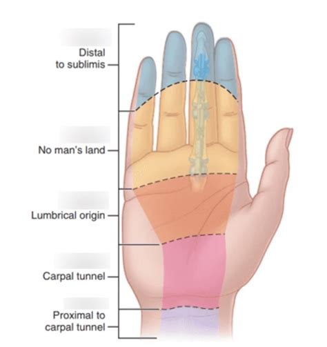 Flexor Tendon Zones Diagram | Quizlet