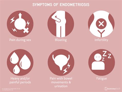 Endometriosis | Symptoms & Treatments & Support | AnatomyStuff