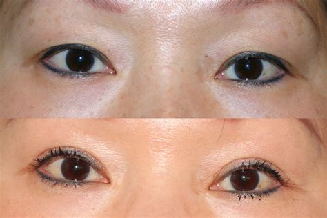 Eyelid Lift