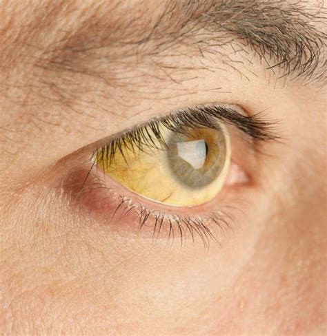 Yellow eyes: Causes in newborns, children, and adults