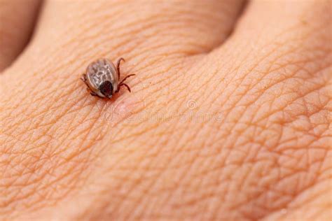 Tick Filled with Blood on Human Skin Stock Image - Image of borne ...