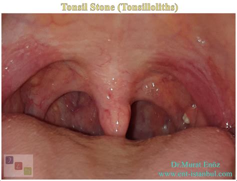 Tonsil Stone - Definition, Symptoms and Treatment