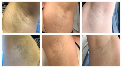 Underarm Laser Hair Removal - Your Questions Answered!