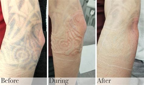 Details 64+ tattoo removal result - in.coedo.com.vn