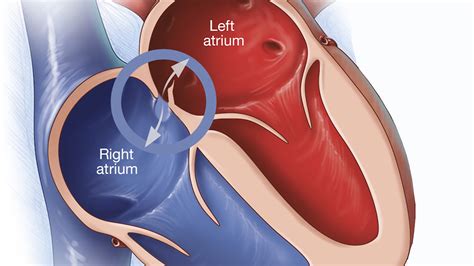 Foramen Ovale