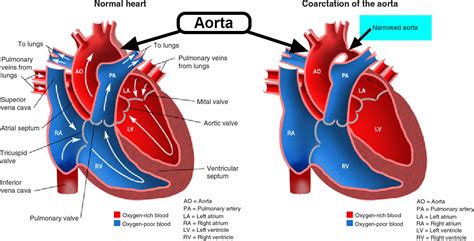 Coarctation of Aorta - In Infants - Symptoms, Murmur, Surgery