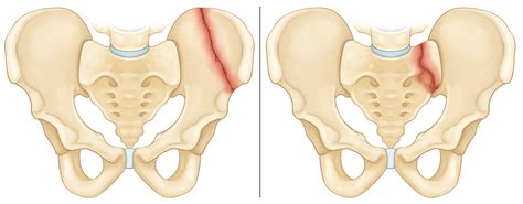 Pelvic Fractures - OrthoInfo - AAOS