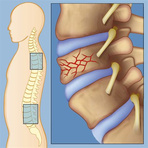 Anterior Wedge Fracture - A Little Piece of Information