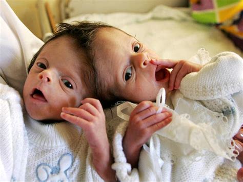 Conjoined twins - Conjoined twins (WARNING: GRAPHIC IMAGES) - Pictures ...