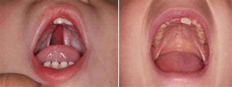 Cleft Palate Surgery for Children | Children's Minnesota