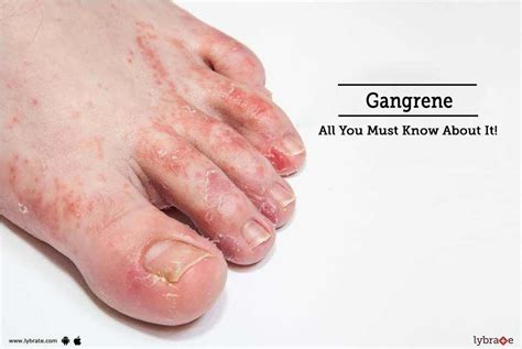 Gangrene - All You Must Know About It! - By Dr. Milind Ruke | Lybrate