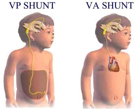 ventricloperitoenal and ventriculoatrial shunt - جستجوی Google ...