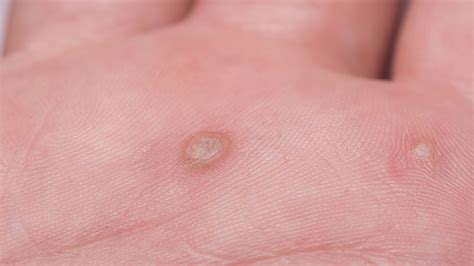 Pictures Of Warts On Children S Body - Infoupdate.org