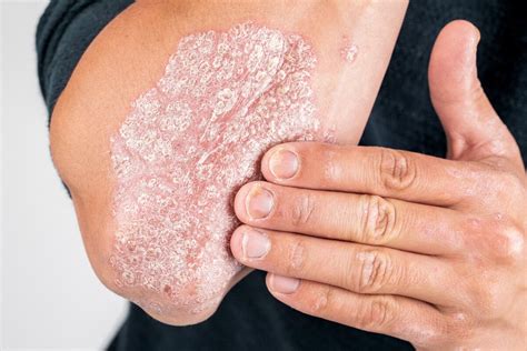 Debilidad condado Hacia arriba psoriasis codos Feudo pista Con qué ...