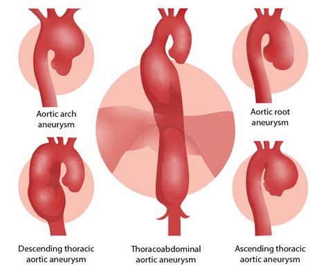 Thoracic Aortic Aneurysm Classification