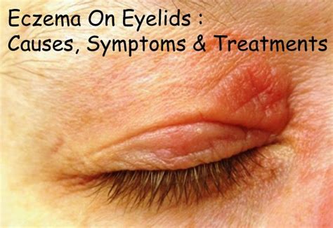 Eczema On Eyelids : Causes, Symptoms & Treatments - Disfreeskin