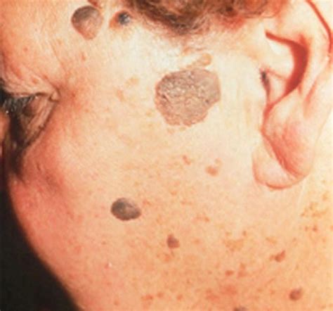 Wisdom Spots On Skin