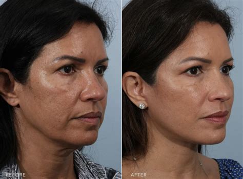 How Much Does a Facelift Cost? | Williams Center Williams Center