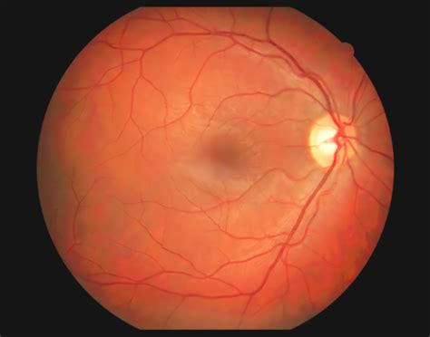 fluorescein-angiography-708x556-2x