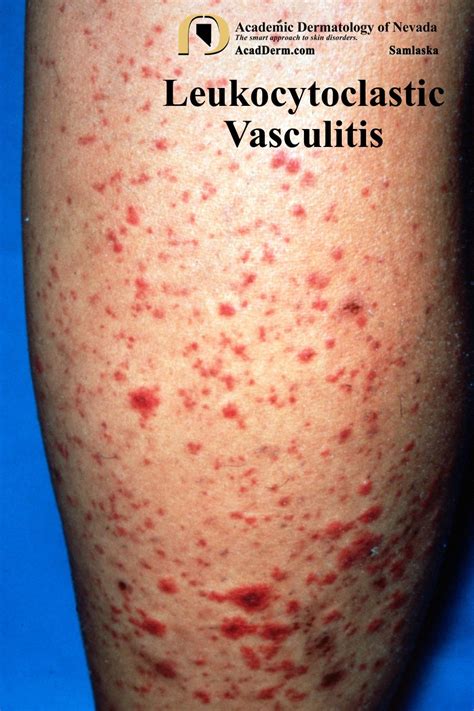 Leukocytoclastic Vasculitis: Small-Vessel Vasculitis... - Academic ...