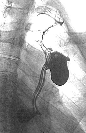 Surgical Management of Late Complications After Colonic Interposition ...