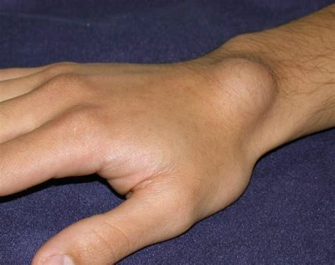 Ganglion Cyst Wrist - Pictures, Treatment, Surgery, Causes, Symptoms