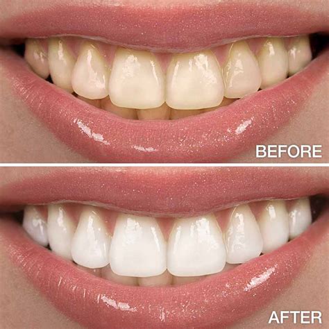 Expert Teeth Whitening: Techniques, Price And Even More