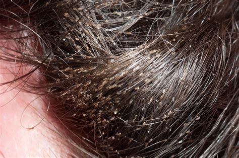 What lice beneath | The BMJ