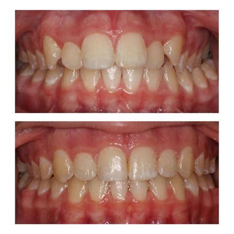 Posterior Crossbite in Jupiter, FL - Meier Orthodontics