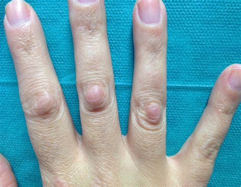 RACGP - Enlarging knuckle bumps