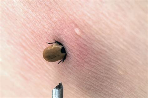 Stay Safe: How to Remove a Tick Correctly