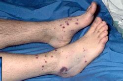 Vasculitis IgA (púrpura de Schönlein-Henoch) | Vasculitis UK | IWOFR