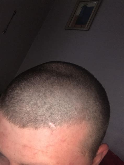 What is this dent on my head? : r/medical_advice