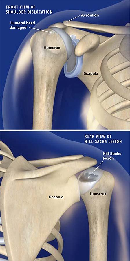 Hill-Sachs Lesion | Central Coast Orthopedic Medical Group