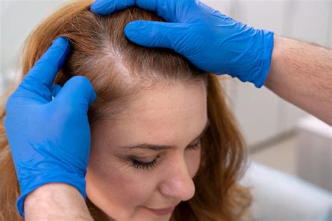 Tipos de alopecia en mujer y caída pelo femenina - Capilclinic ️