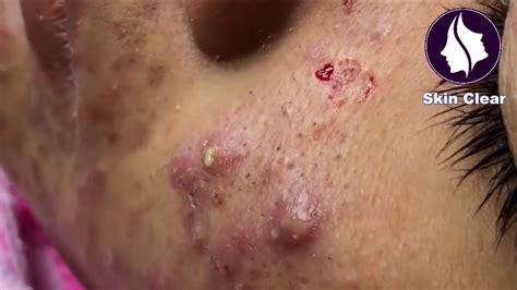 Blackheads Removal Best Pimple Popping #18 - YouTube