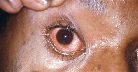 Gonorrhea symptoms eyes - ezgross