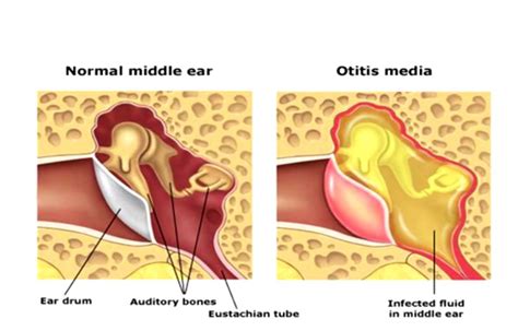 Middle Ear Infection - Cure For Otitis Media