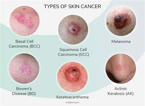 Skin Cancer On Face Early Signs