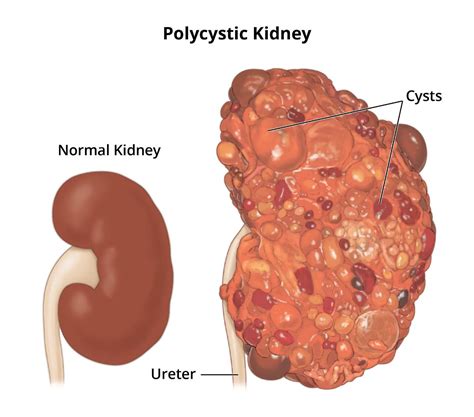 Polycystic Kidney Disease Pathophysiology