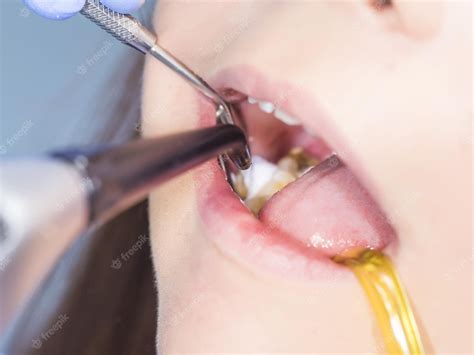 Premium Photo | Treating cavity