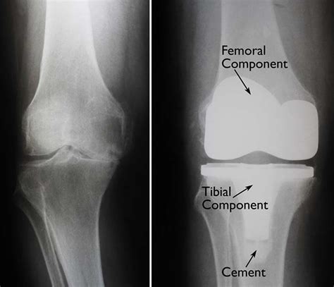 Knee Replacement - Surgery, Recovery Time, Complications