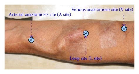 (a) Arteriovenous shunt and its measurement sites, (b) Doppler ...