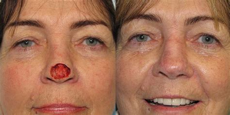 Nose-Reconstruction-After-Skin-Cancer-Excision-Skin-Cancer-And ...