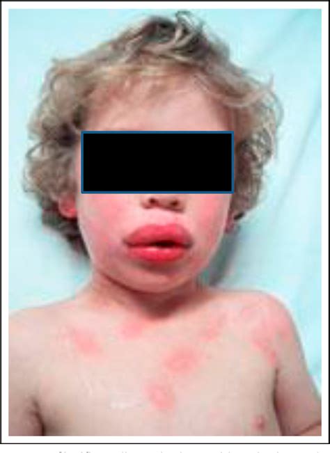 Figure 3 from Anaphylaxis, urticaria, and angioedema. | Semantic Scholar