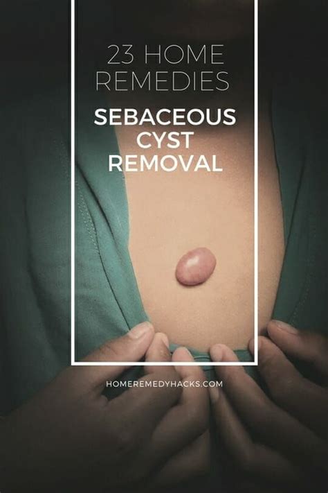 Home Remedies for Sebaceous Cyst Removal | Cysts, Epidermoid cyst, Home ...